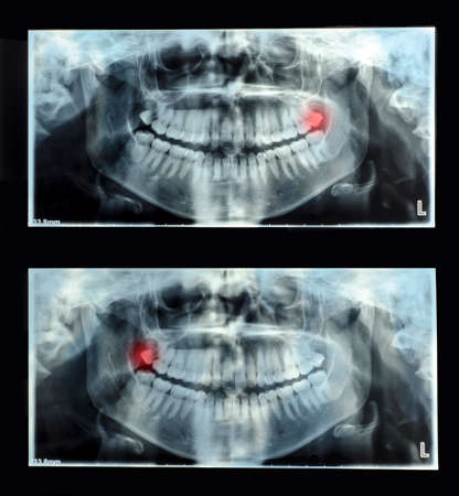 Panoramic dental x-ray  with superior upper wisdom tooth (eight tooth) shown red. Double x-rayの写真素材