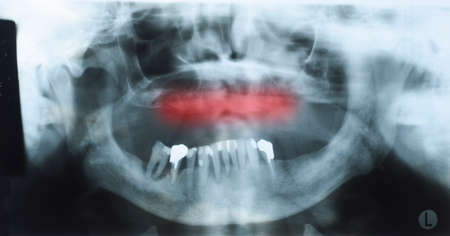 Panoramic dental x-ray of an old person with some lower teeth and no tooth of the upper shown red. Selectionの写真素材