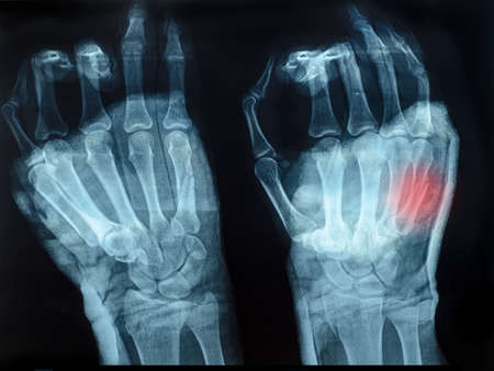 X-Ray image of human hands with top hand shown red for fractureの写真素材