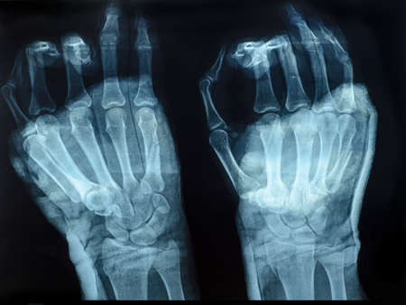 X-Ray examination image of human handsの写真素材