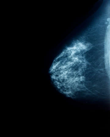 Mammography, medical examination for women. Profile viewの写真素材