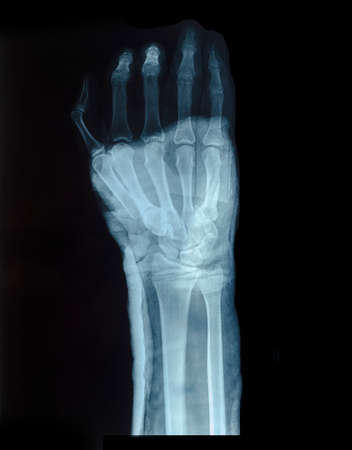 X-Ray image of human hand for fractureの写真素材