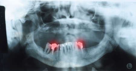 Panoramic dental x-ray of an old person with some lower teeth and no tooth of the upper. Prosthesis shown red. Selectionの写真素材