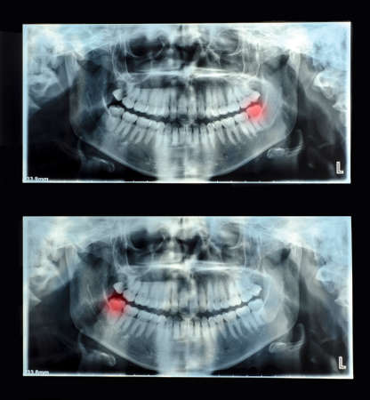 Panoramic dental x-ray  with superior upper wisdom tooth. Doublex-rayの写真素材