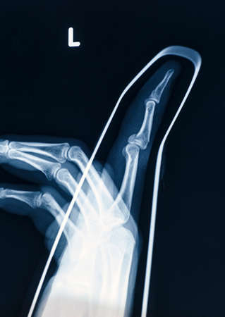 X-Ray image of human hand with stick for fractureの写真素材