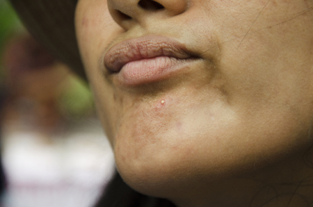 Acne or pimple obstruction on chin and face of asian thai womenの写真素材