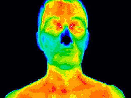 Thermographic image of a human face showing different temperatures in a range of colors from blue showing cold to red showing hot which can indicate inflammation.の写真素材