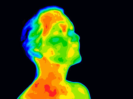 Thermographic image of a human face and neck showing different temperatures in a range of colors from blue cold to red hot. Red in the neck might indicate raised CR-P levels, this could be a sign of inflammation, and Carotid Artery inflammation which coulの写真素材