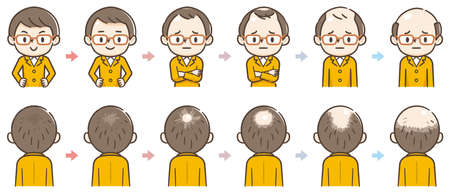 Information chart of hair loss stages types of baldness illustrated on male head vector.のイラスト素材