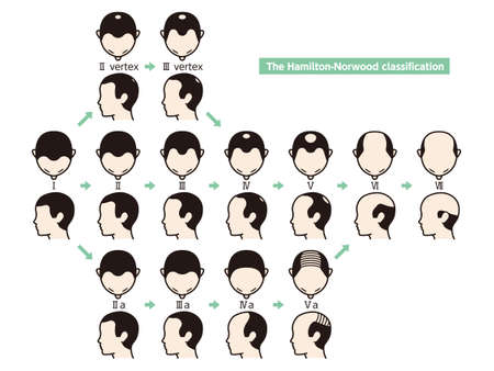 Information chart of hair loss stages and types of baldness illustrated on a male head.のイラスト素材