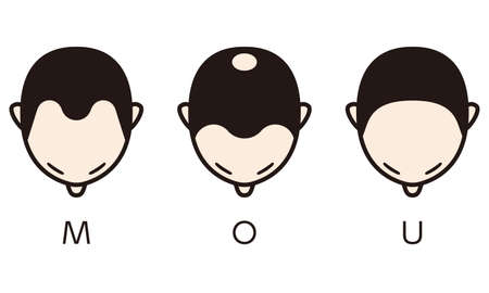 Information chart of hair loss stages and types of baldness illustrated on a male head.のイラスト素材