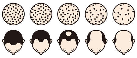 Information chart of hair loss stages and types of baldness illustrated on a male head.