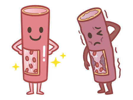 Illustration of healthy and unhealthy blood vesselsのイラスト素材