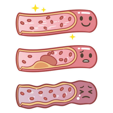 Healthy and atherosclerosis vessels with blood cells vector illustrationのイラスト素材