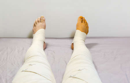 Outstretched human legs tight wrapped with woven elastic medical bandages and fixed with clips on...