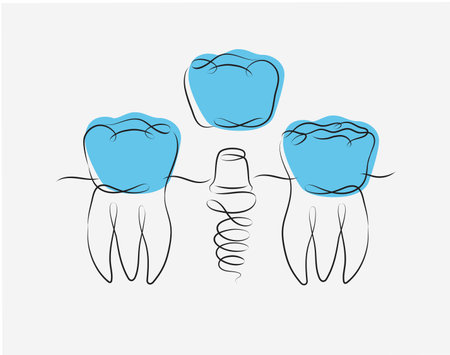 Teeth implant illustration drawing in linear style on white and blue backgroundのイラスト素材