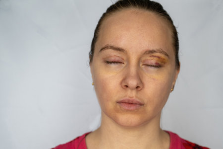 woman face recovery after plastic surgery, blepharoplasty operation, visible eyes wound cuts, swelling eye bags, swollen skin sutures and bruised eyelids. Cosmetic surgeryの写真素材