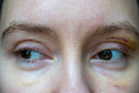 woman face recovery after plastic surgery, blepharoplasty operation, visible eyes wound cuts, swelling eye bags, swollen skin sutures and bruised eyelids. Healing process of creaseの写真素材