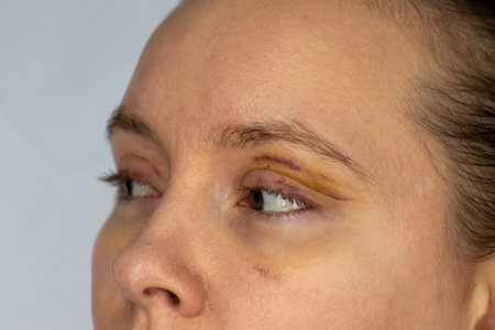 woman face recovery after plastic surgery, blepharoplasty operation, visible eyes wound cuts,...