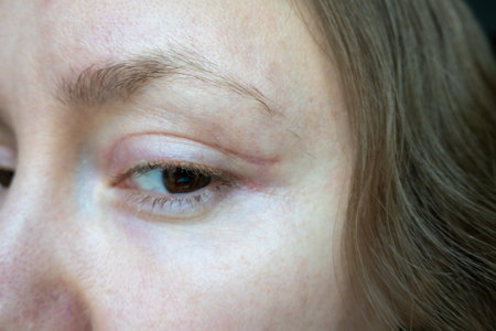 woman face after plastic surgery on eyes, blepharoplasty operation, incisions stitches, healing after operation, scar from surgical cut on eyelid, healed wound skinの写真素材