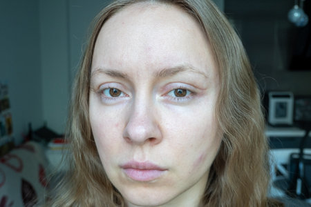 woman face after plastic surgery on eyes, blepharoplasty operation, incisions stitches, healing after operation, scar from surgical cut on eyelid, healed wound skin