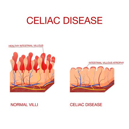 Coeliac disease or celiac disease.Healthy and damaged villiのイラスト素材