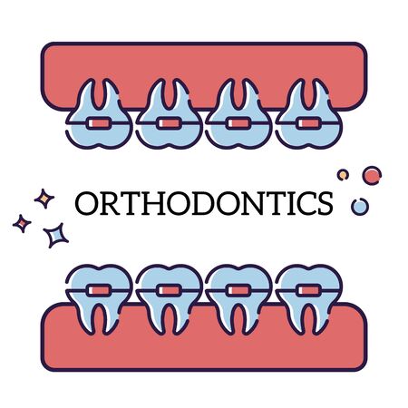 Vector flat illustration on white background in cartoon style. Jaw with teeth in braces. Orthodontist procedureのイラスト素材