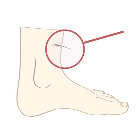 Hair removal laser on vectorのイラスト素材