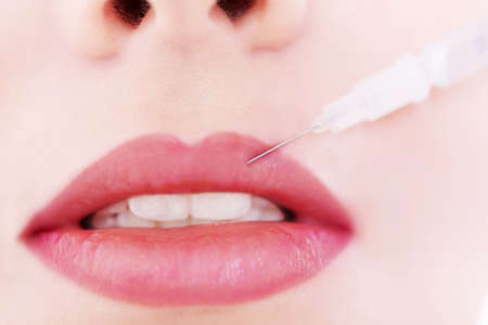 Hyaluronic injection with beauty for perfect lipsの写真素材
