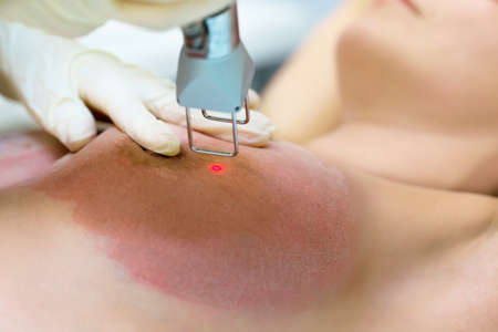 Laser removal of stretch marks on the skin the breast in medical centreの写真素材