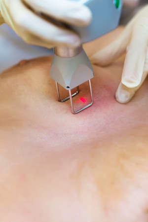 Laser removal of stretch marks on the skin the breast in medical centreの写真素材