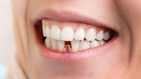 Dentist tools. Beautiful young woman smile with closeup of tooth implant for healthcare design. Healthy teeth. Orthodontic treatment. Dental care.の写真素材