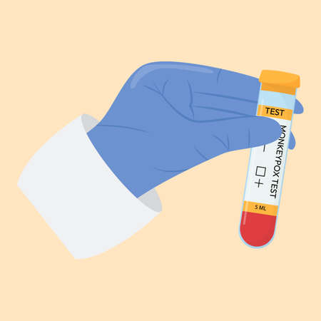 The hand of a doctor in a protective glove holds a test tube. Monkeypox virus test. Positive or...