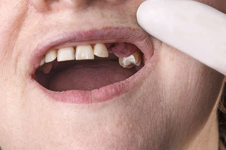 Examination of the oral cavity at the dentist. Temporary tooth filling. Pulled out teeth.