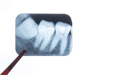 X-ray of wisdom teeth in the dentist's handsの写真素材