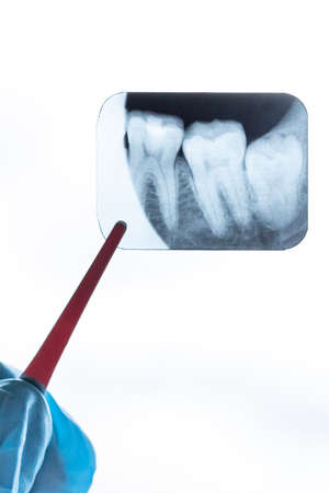 X-ray of wisdom teeth in the dentist's hands