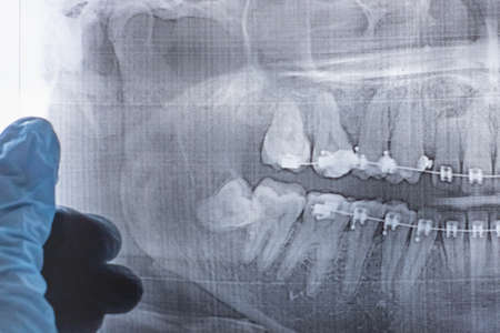 gloved dentist surgeon holds x-ray of lower retarded wisdom toothの写真素材
