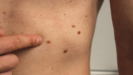 Male hand showing birthmarks on skin body stomach part. Close up detail of the bare skin. Health Effects of UV Radiation. Man with birthmarks Pigmentation and lot of birthmarksの写真素材