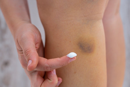 Unrecognized person rubbing recovery healing cream on bruises at home scene. Close-up of woman with bruised leg. Bruising leg area, injury accident.の写真素材