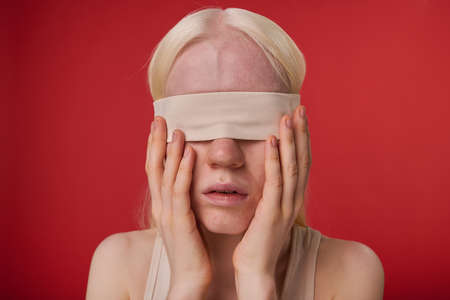 Portrait of young albino girl with bandage on her eyes isolated on red backgroundの写真素材