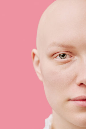 Portrait of young adult Caucasian woman with alopecia looking into camera, closeup showing smooth bald scalp and natural facial features against pink backgroundの写真素材