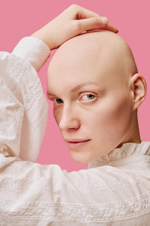 Portrait of young adult Caucasian woman touching smooth bald scalp, turning head toward camera, showing facial features and clear skin, representing alopecia awarenessの写真素材