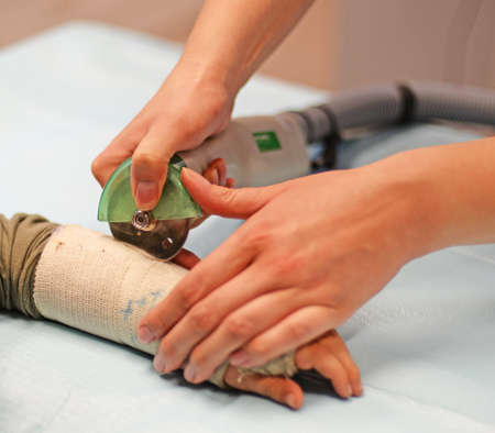Paramedic using plaster saw to remove old and dirty plaster cast from young boyâs broken left arm. Selective focusの写真素材