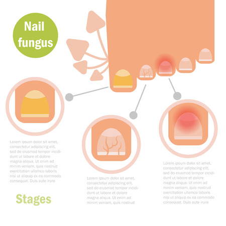 Nail fungus infection. Vector. Cartoon Isolated Flatのイラスト素材