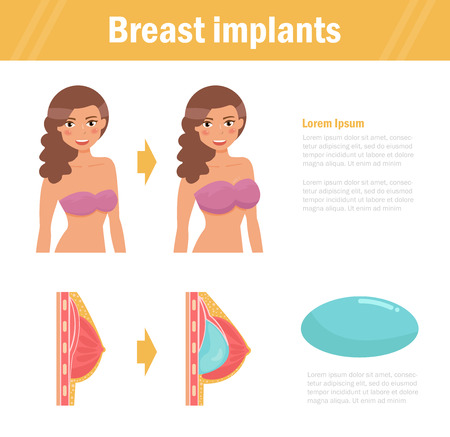 Breast implants. Cartoon. Isolated. Flat. Illustration for websites brochures magazines Increase enhancement raisingのイラスト素材