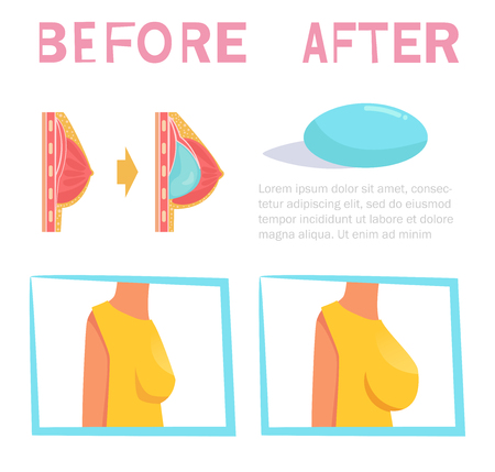 Before and after. Breast surgery. Implants Vector. Cartoon. Isolated art on white background.のイラスト素材