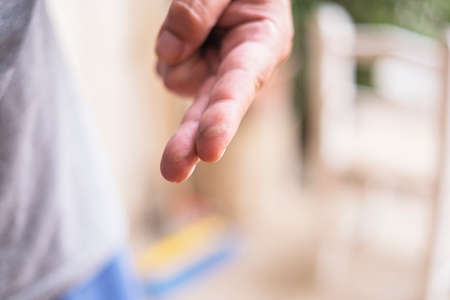 Close up of the fingers on the hand severely burnedの写真素材