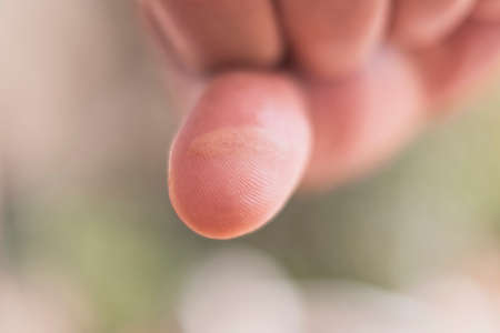 Close up of the fingers on the hand severely burned