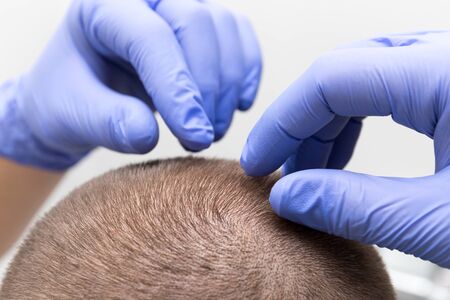 the doctor checking a young man hair for head lice on white background