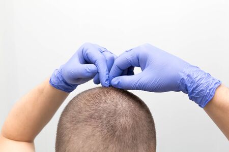 the doctor checking a young man hair for head lice on white backgroundの写真素材